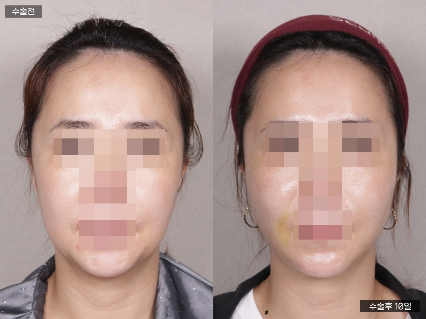 리프팅 [관자거상]