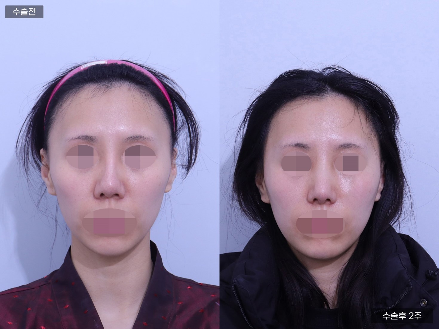 코 재수술 + 코끝 + 매부리코 + 콧볼축소