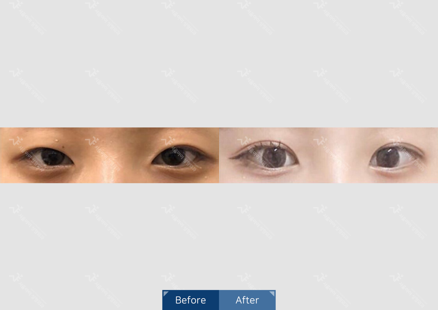 눈성형 [자연유착 쌍꺼풀 + 앞트임]