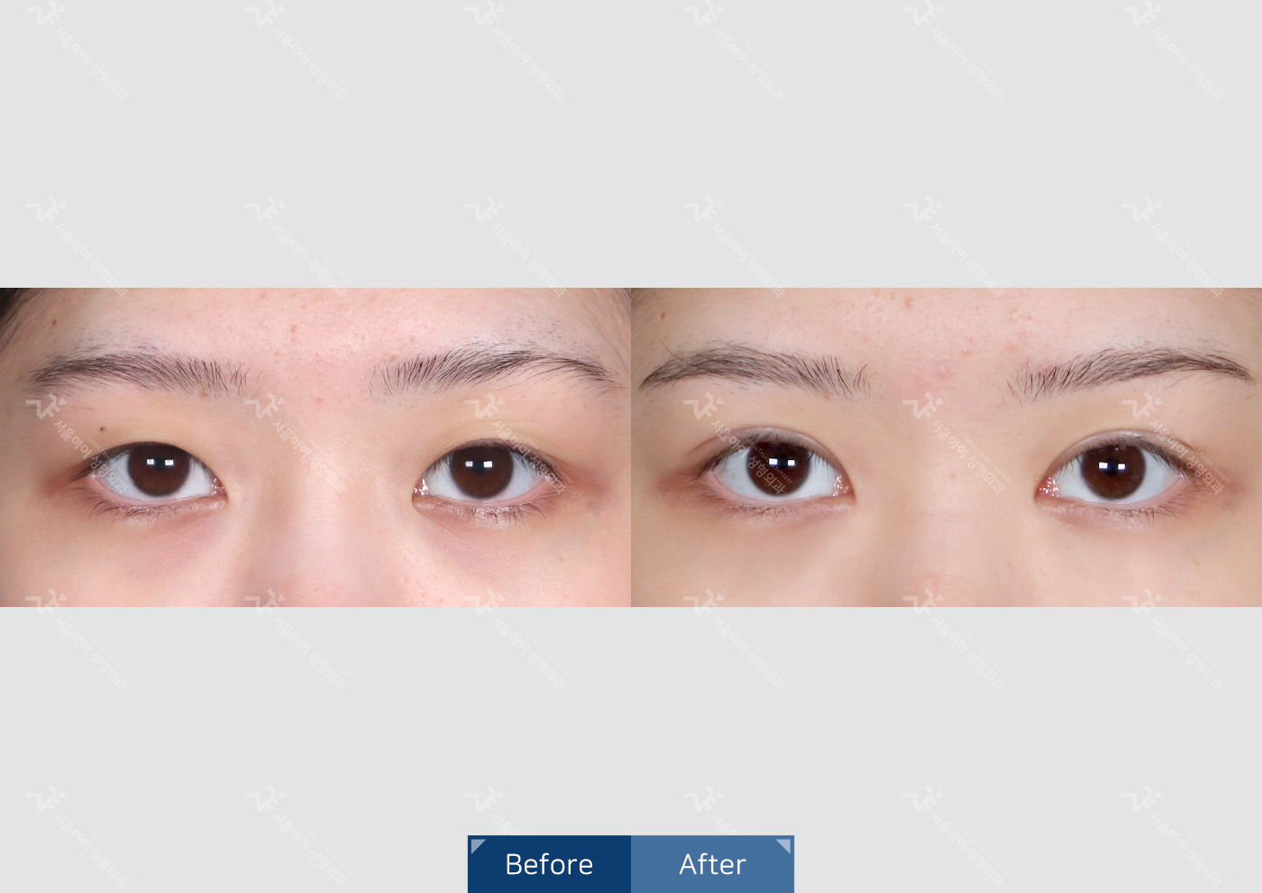 눈성형 [자연유착 쌍꺼풀]