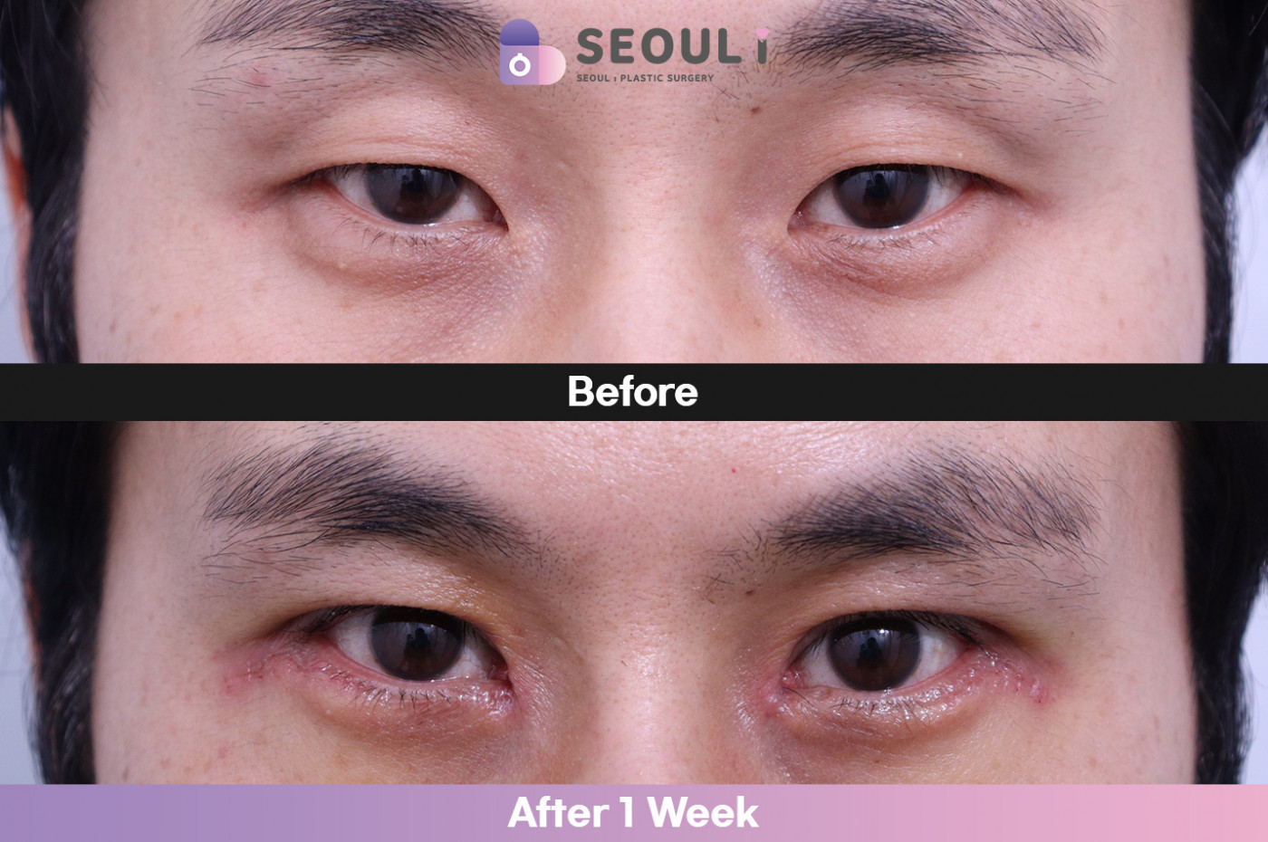 눈성형 [눈매교정 + 앞트임 + 뒷밑트임]