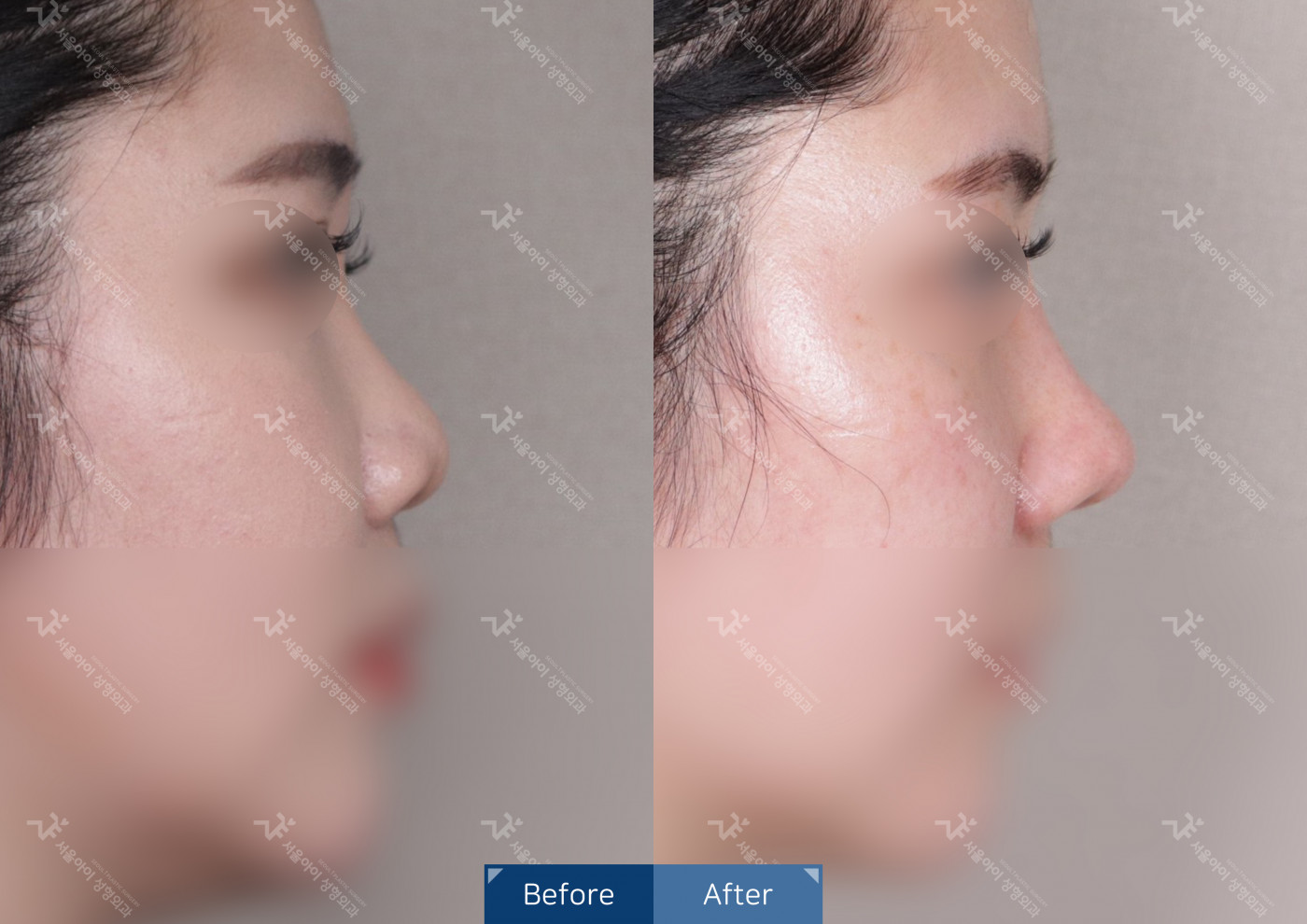 코성형[코끝조각술+복코교정술+휜코교정술+짧은코 교정+메부리코]