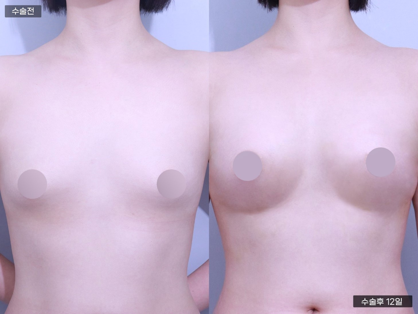 줄기세포 가슴지이 (250CC + 250CC)