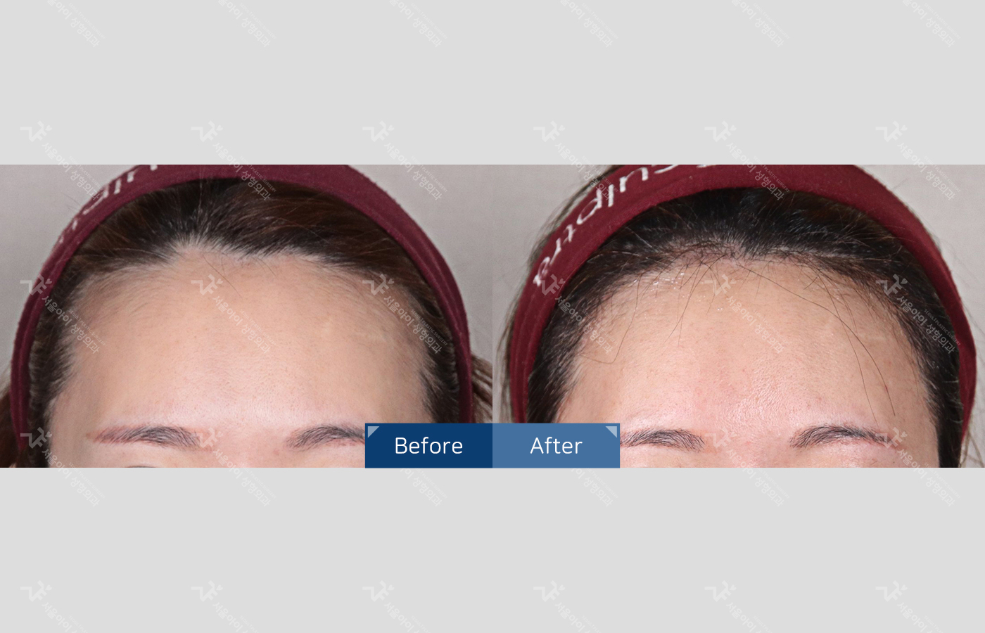 모발이식 [절개 모발이식(3000모) + 헤어라인]