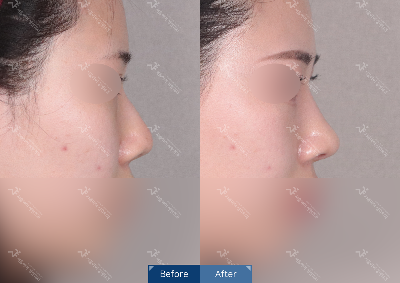 코성형[미용코]