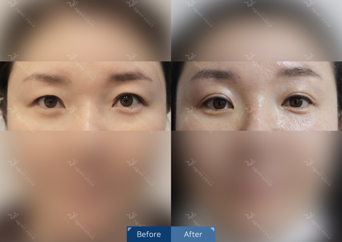 눈성형 [자연유착 + 뒷트임 + 안검하수]