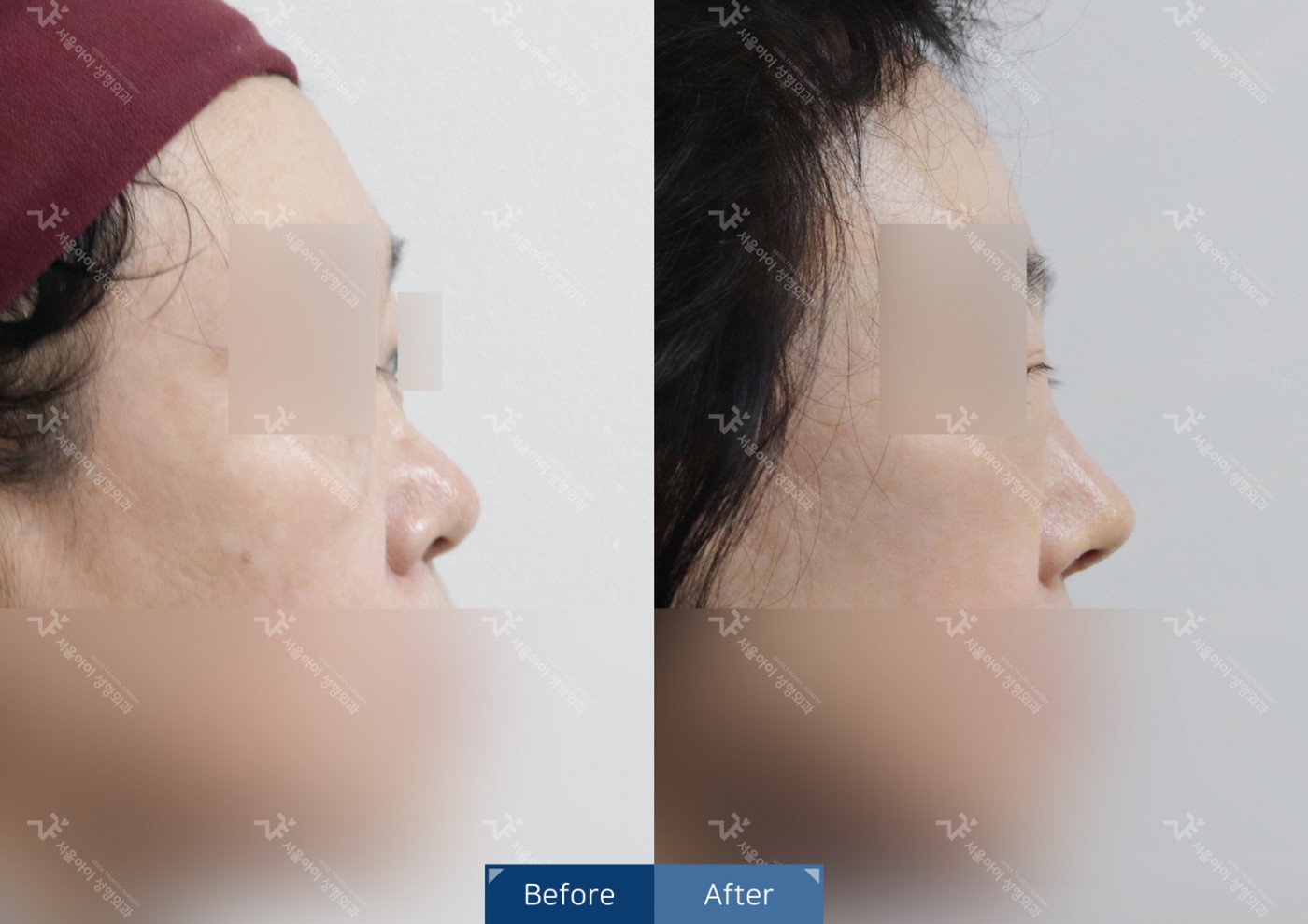 코성형 [융비술+코끝조각술+복코교정]