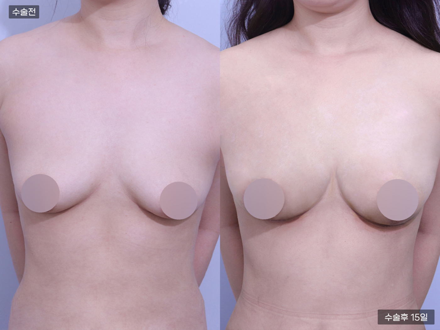 가슴성형 [가슴지방이식(200CC + 200CC)]