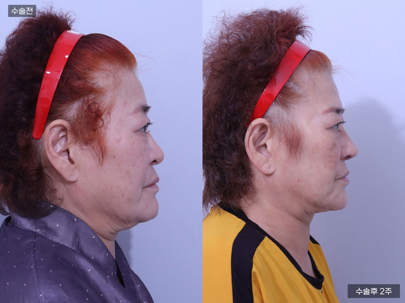 비공내리기 + 복코 + 매부리코