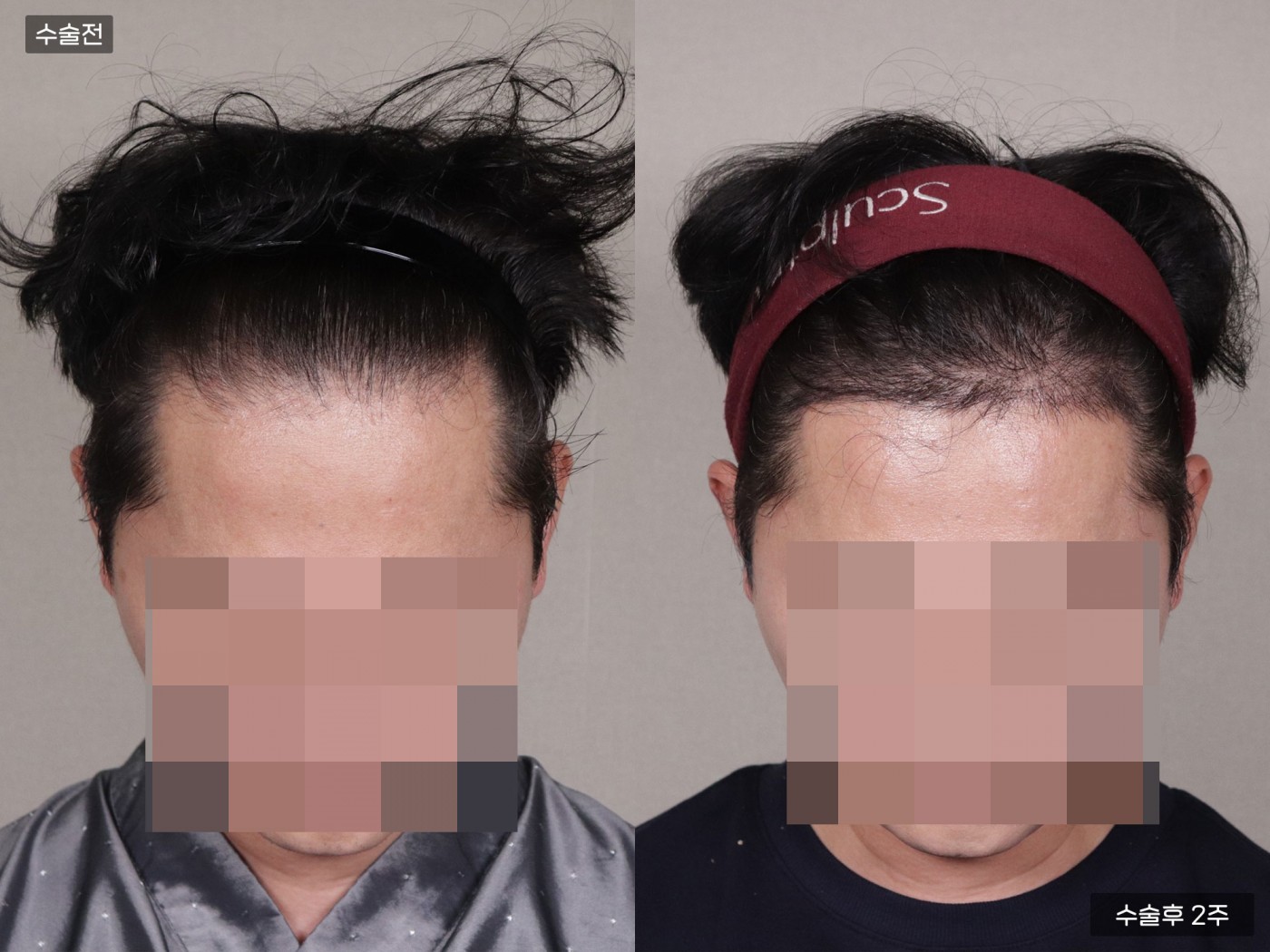 모발이식[절개 모발이식(3000모)]