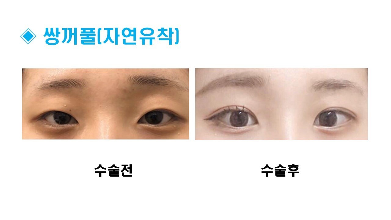 자연유착 쌍꺼풀