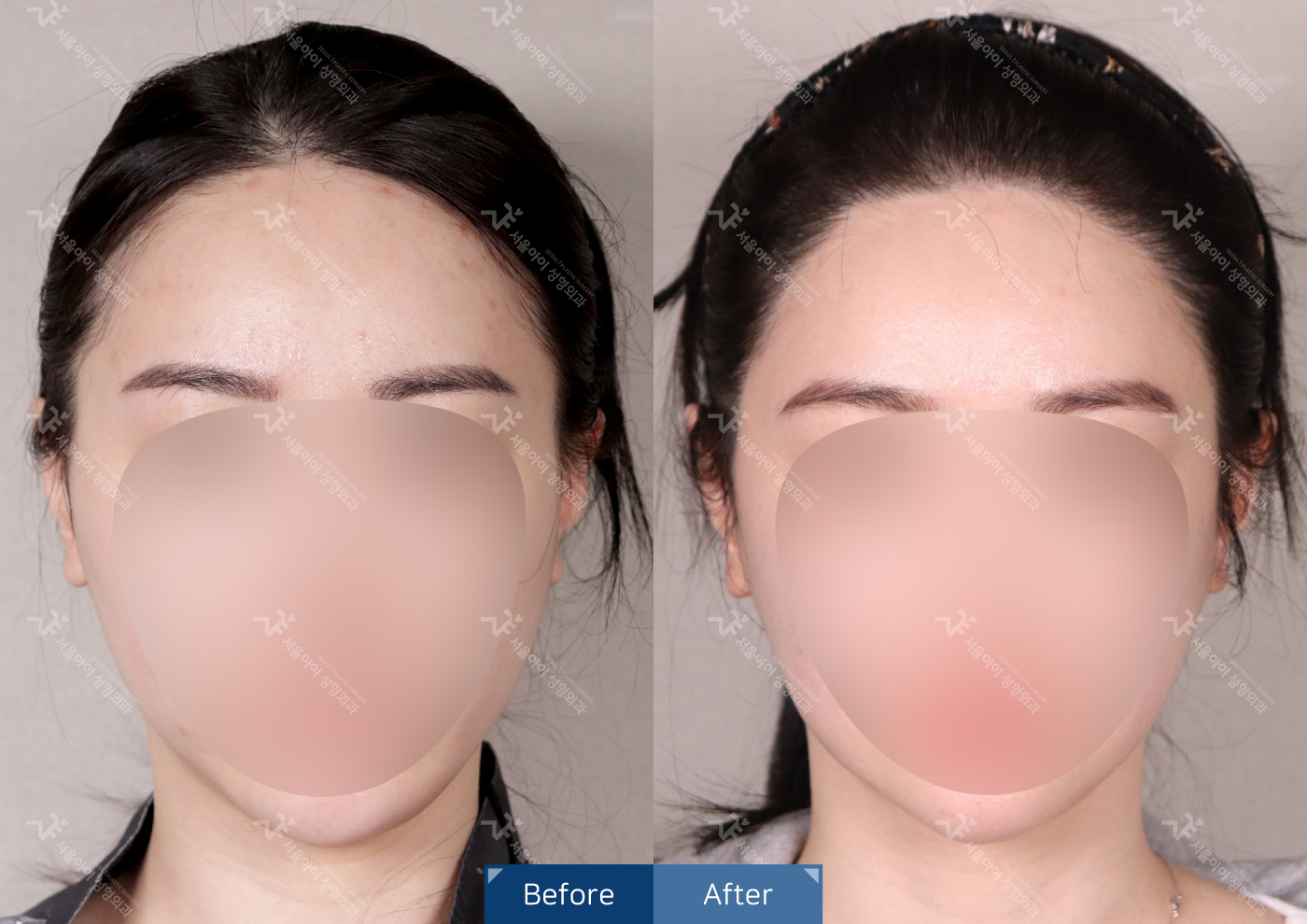 모발이식 [비절개 모발이식(3000모) + 헤어라인 + 엠자]