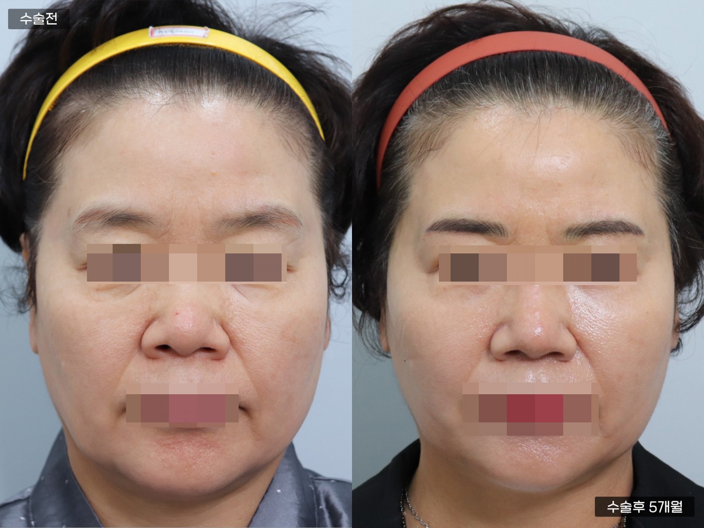 리프팅 [관자거상 + 실리프팅]