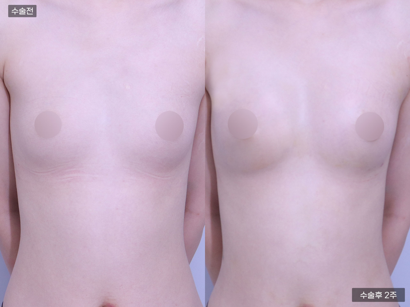 가슴성형 [가슴지방이식(250CC + 250CC)]