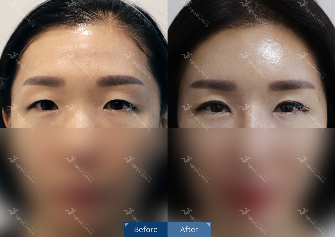 눈성형 [자연유착 쌍꺼풀 + 앞트임]