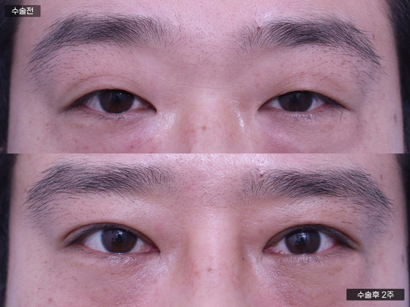 눈성형 [절개 쌍꺼풀 + 눈밑지방재배치]