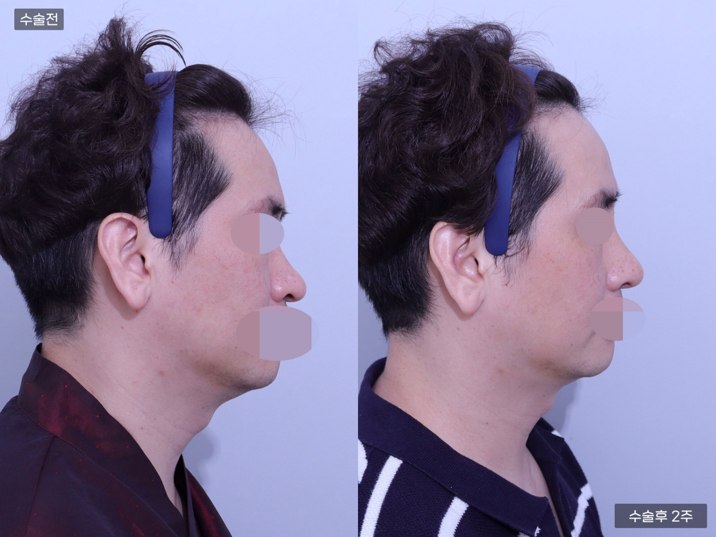 코끝 + 복코 + 비공내리기 + 콧볼축소