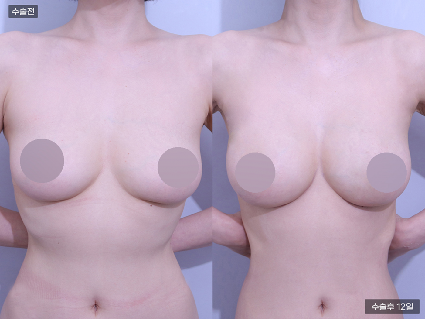 가슴성형 [가슴지방이식(225CC + 225CC)]