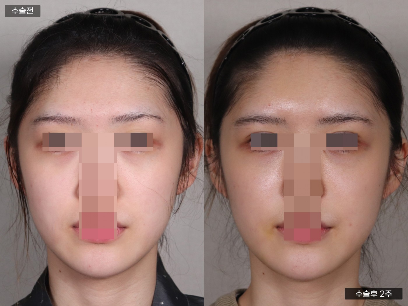 지방이식 [풀페이스]