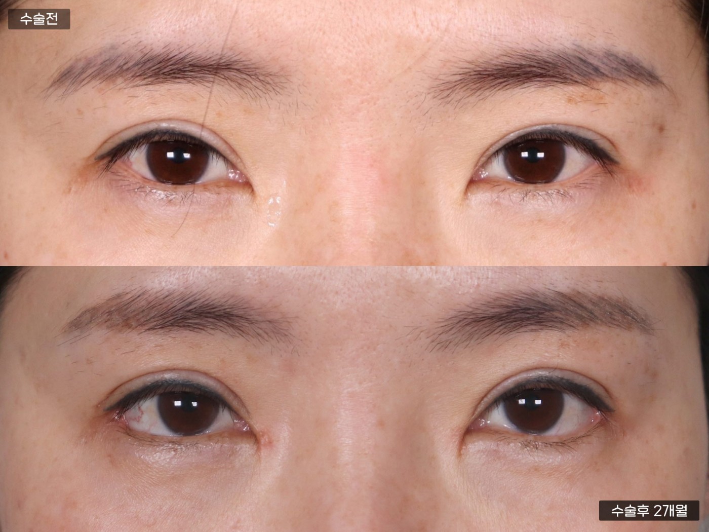 눈성형 [절개 쌍꺼풀 + 앞트임 + 뒷밑트임]