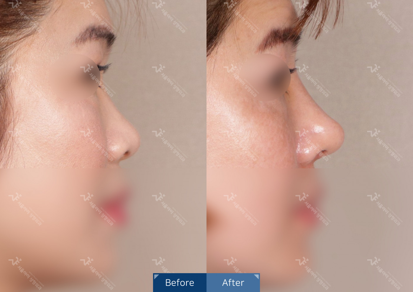 코성형 [코끝조각술+비중격+복코+메부리코]