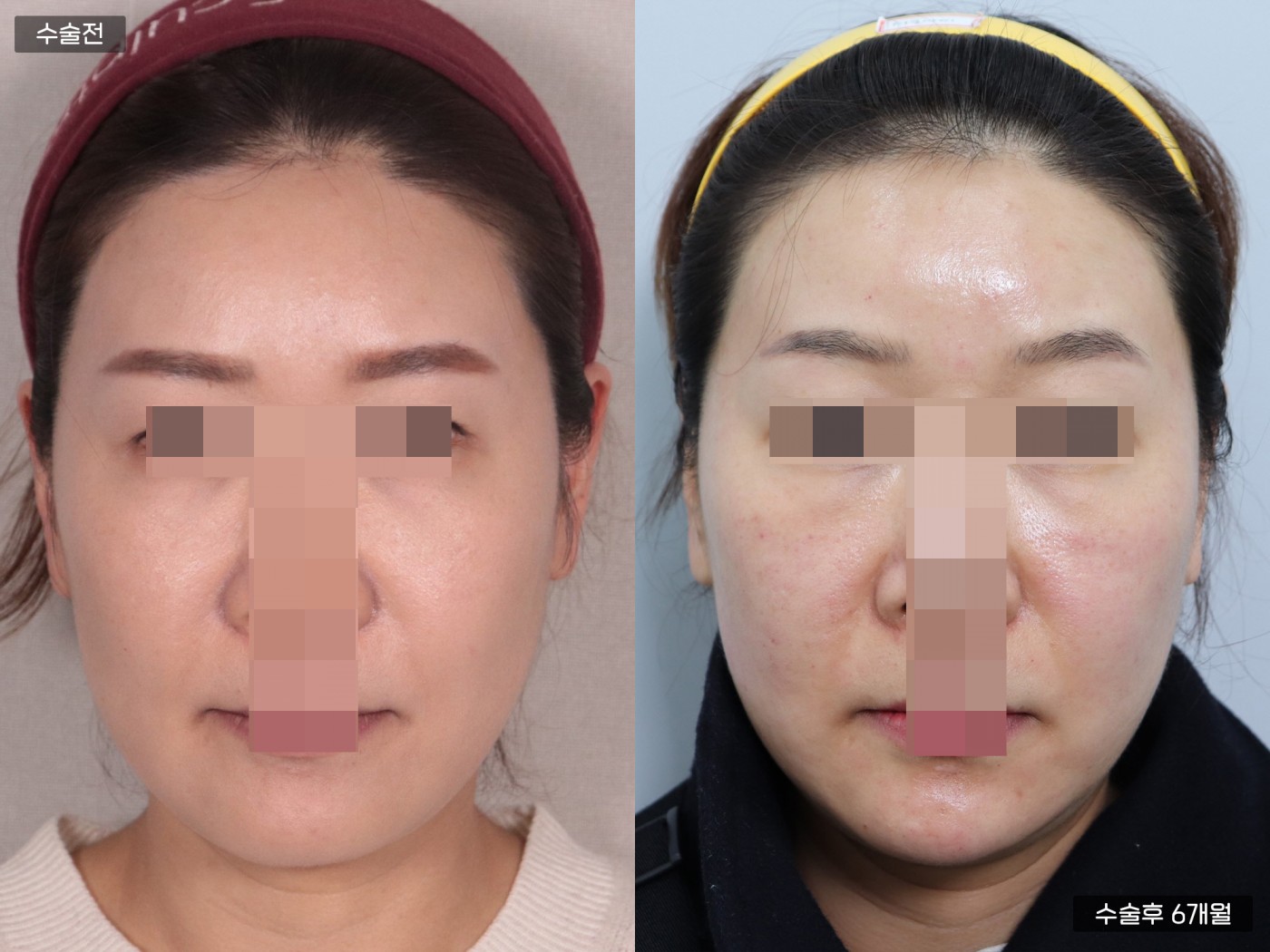 리프팅 [관자거상]