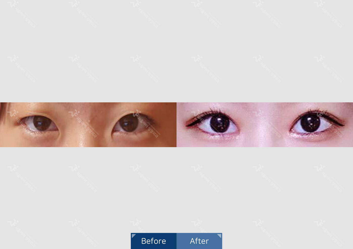 눈성형 [자연유착 쌍꺼풀 + 윗트임]