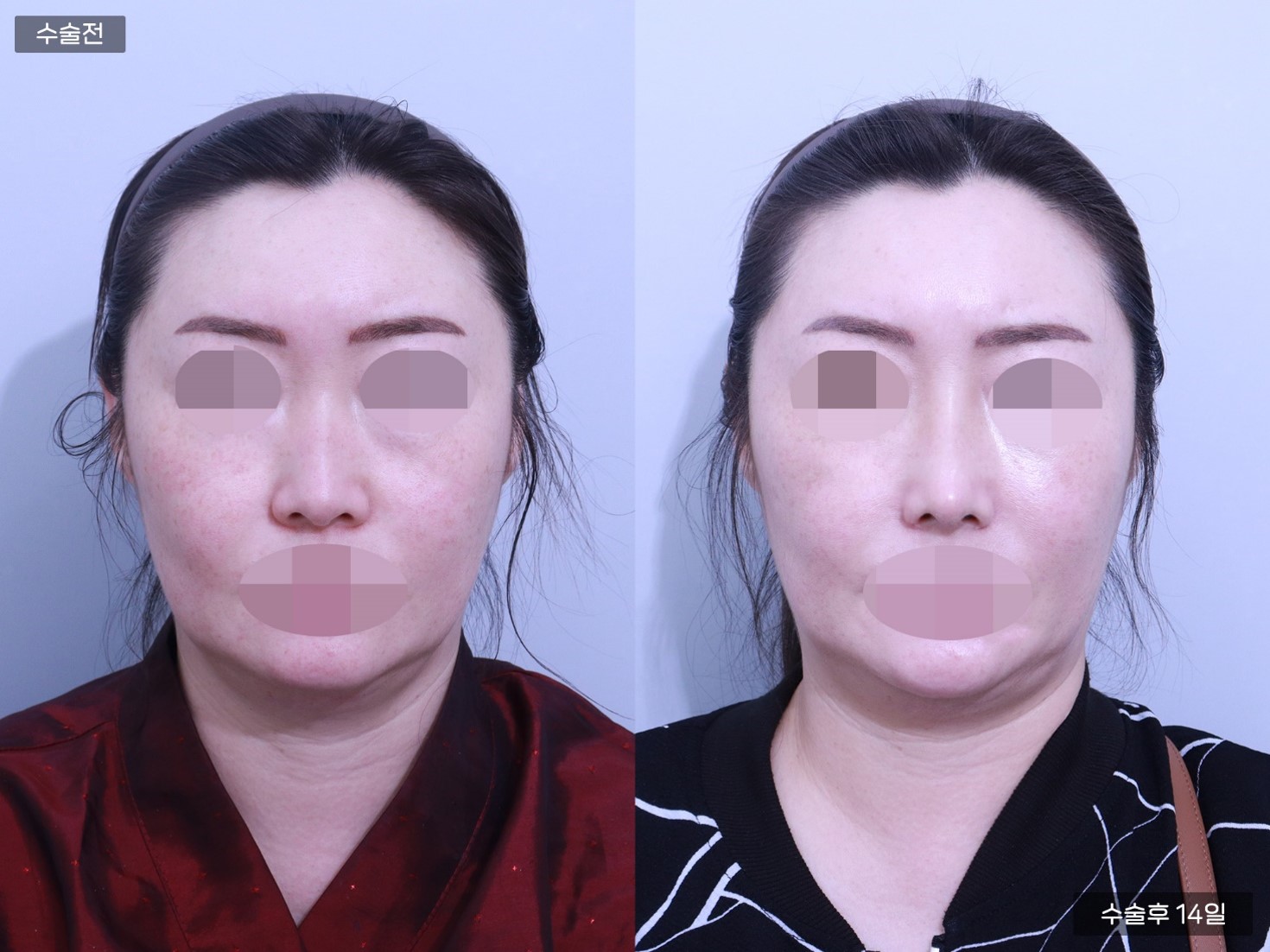 낮은코 + 콧볼축소