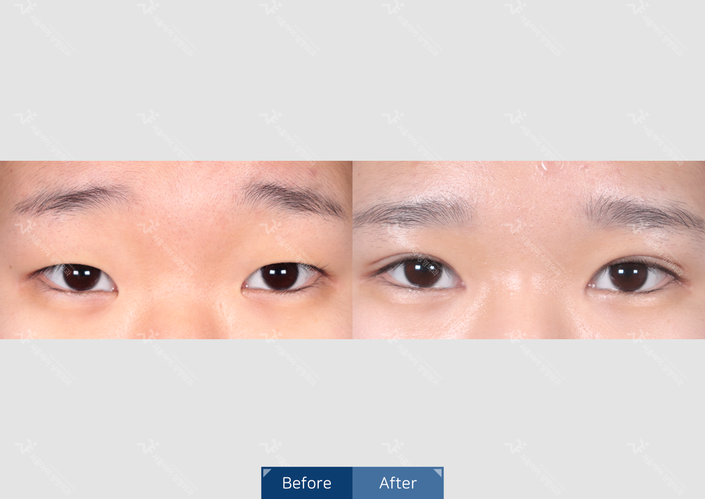 눈성형 [자연유착 쌍꺼풀]