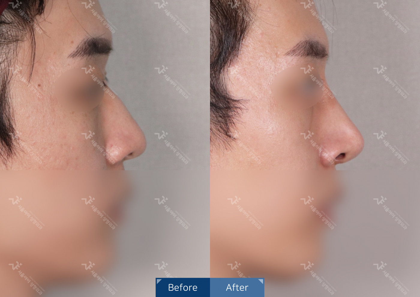 코성형 [코끝조각술+비중격+복코+메부리코]