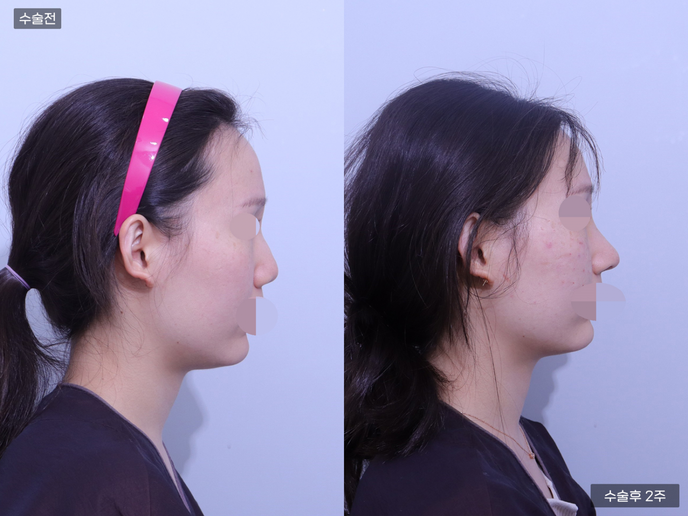 코끝 + 복코 + 매부리코