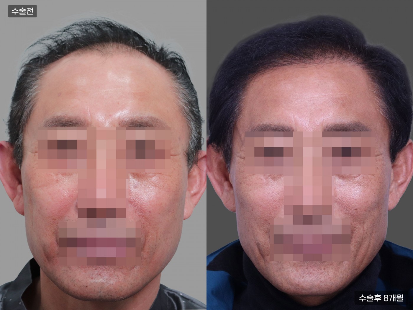 모발이식 [절개 모발이식(4000모)]