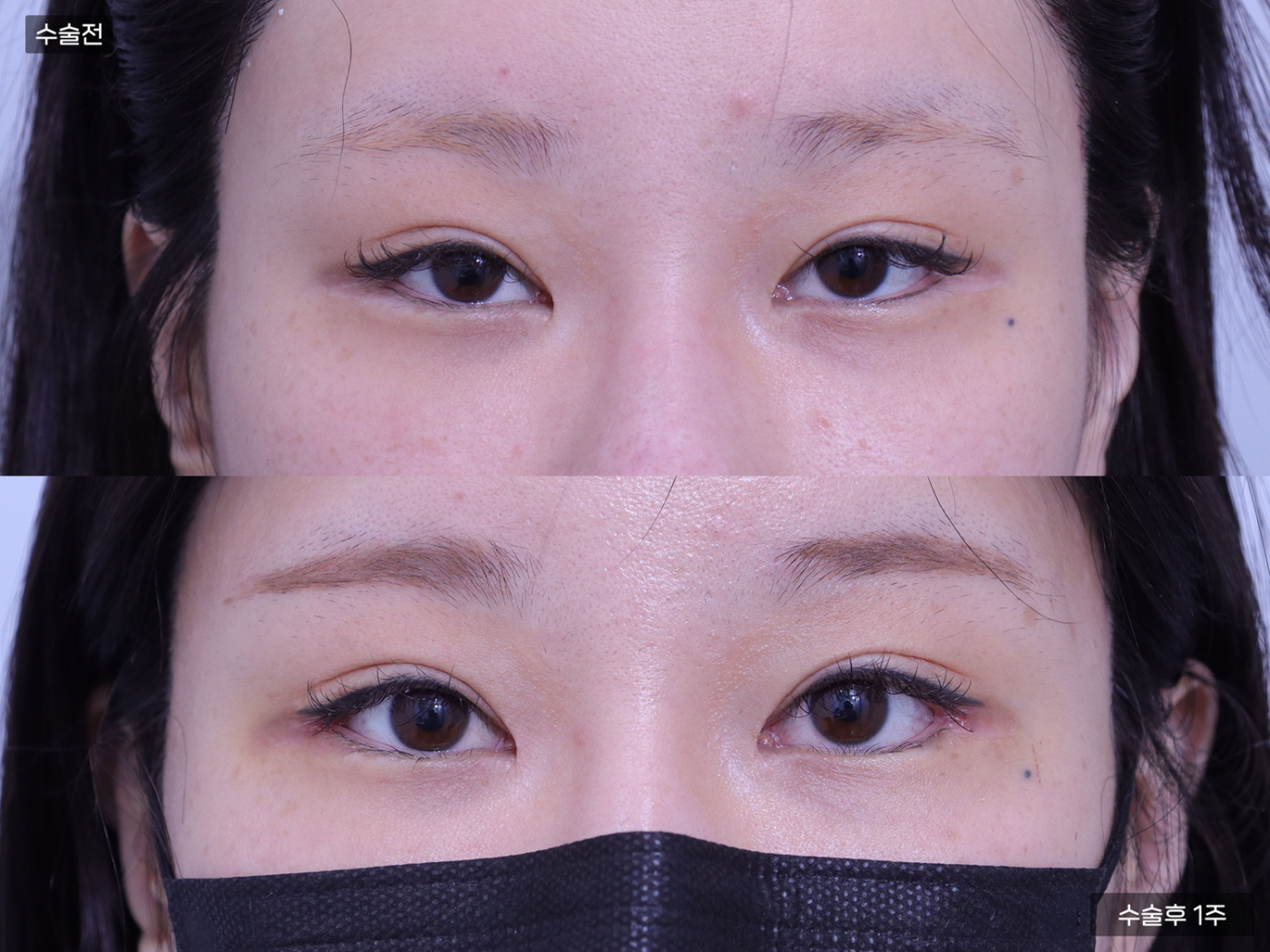 눈성형 [뒷밑트임]