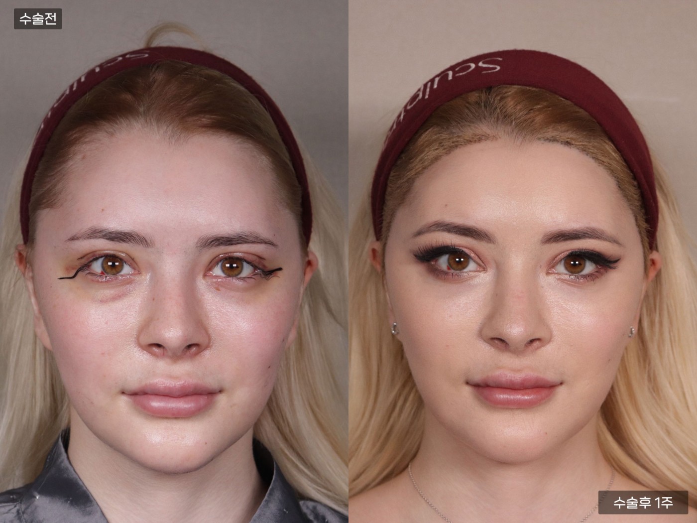 모발이식 [절개 모발이식(4000모)]