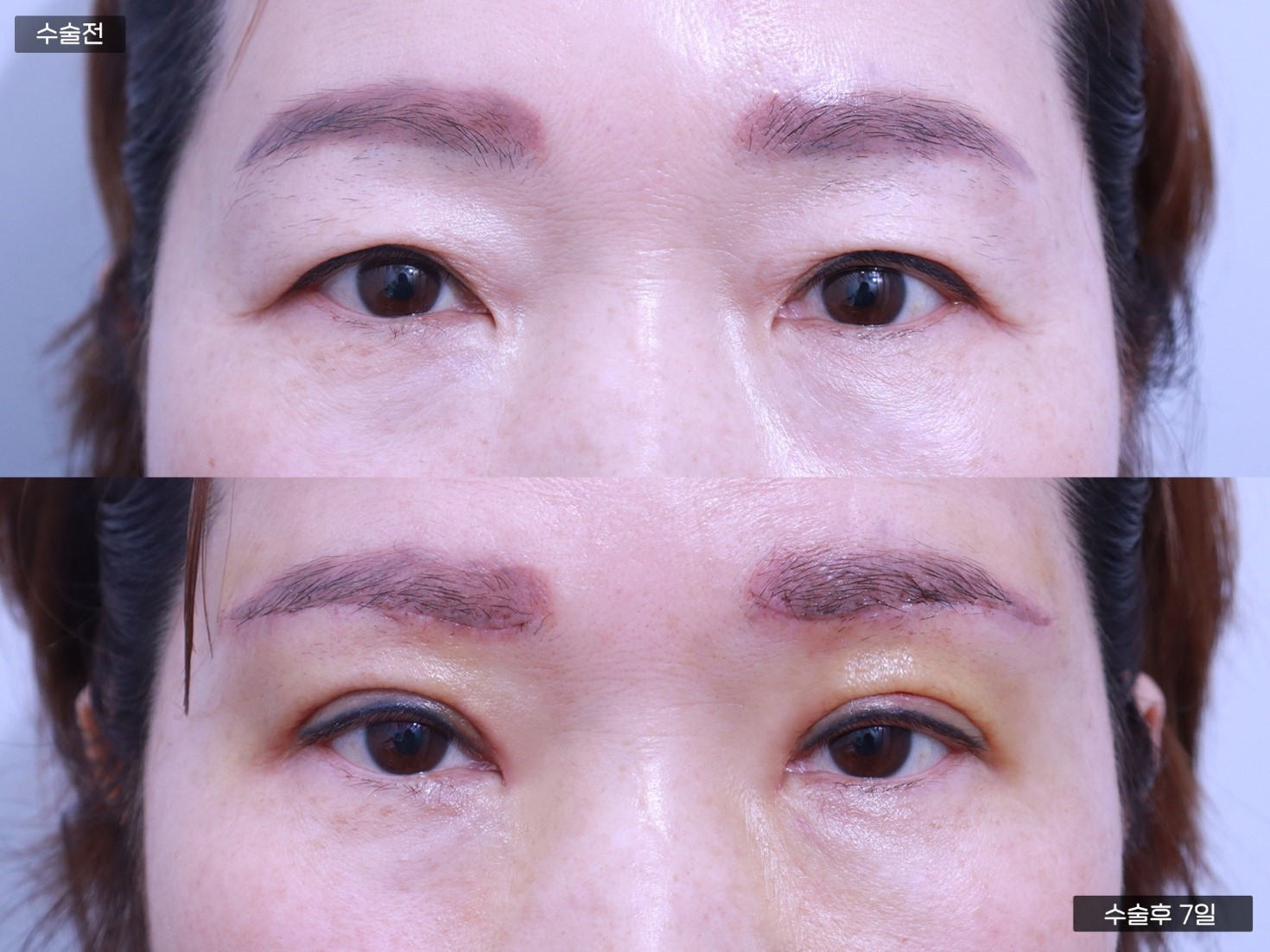 눈재수술 + 자연유착쌍꺼풀 + 눈썹하거상술