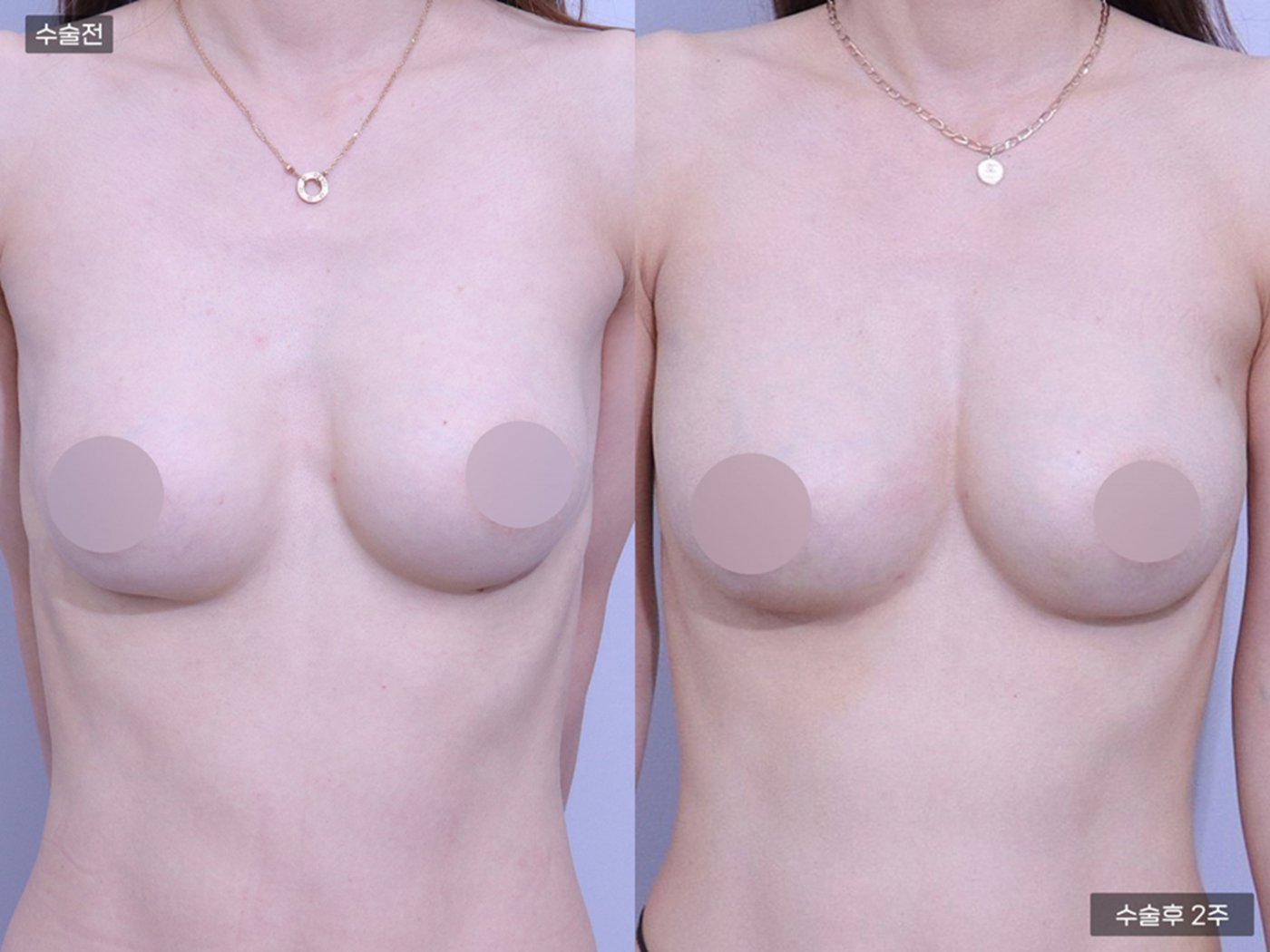가슴성형 [가슴지방이식(170CC + 130CC)]