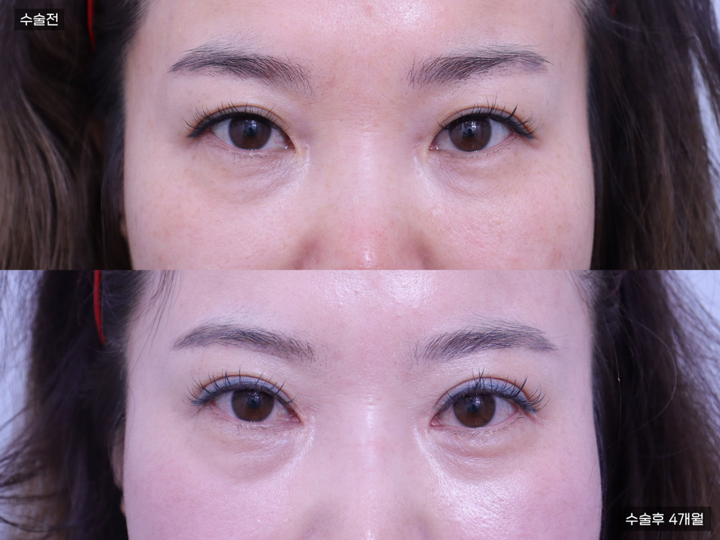 눈성형 [앞트임]