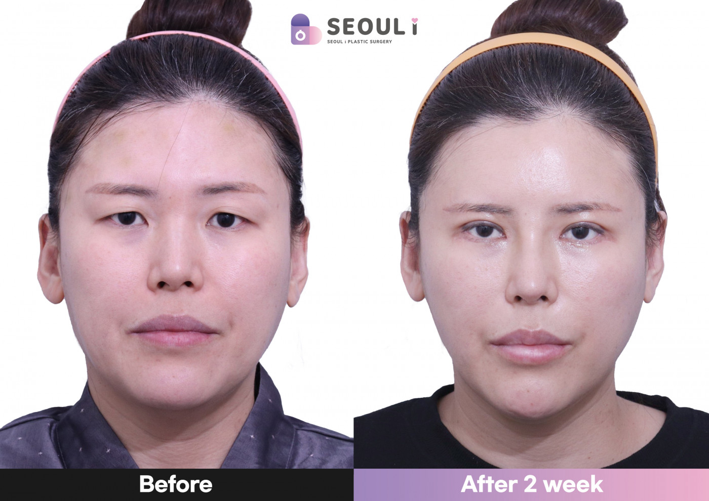 리프팅 [실리프팅]