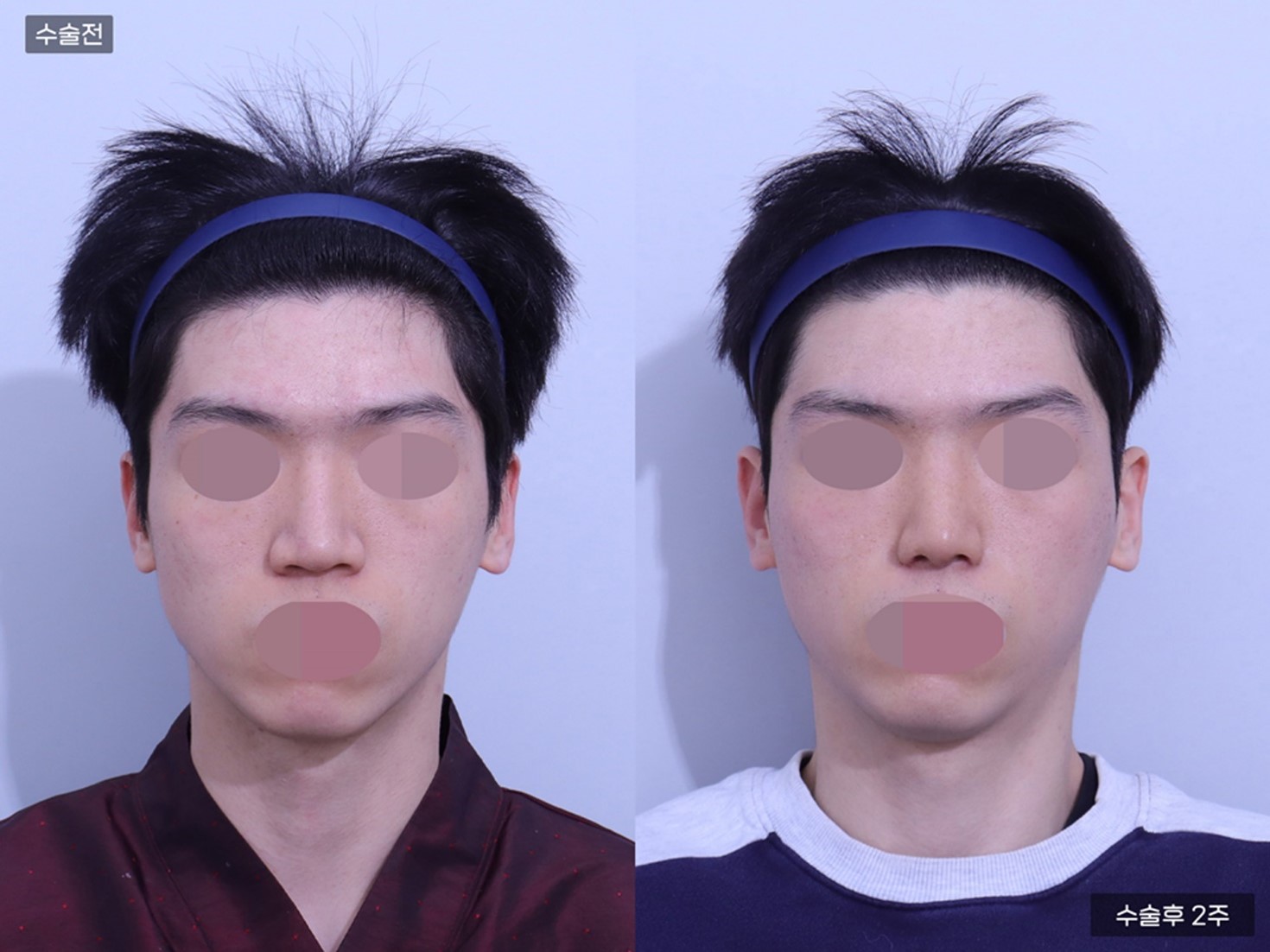 코끝교정 + 매부리코+복코+콧볼축소