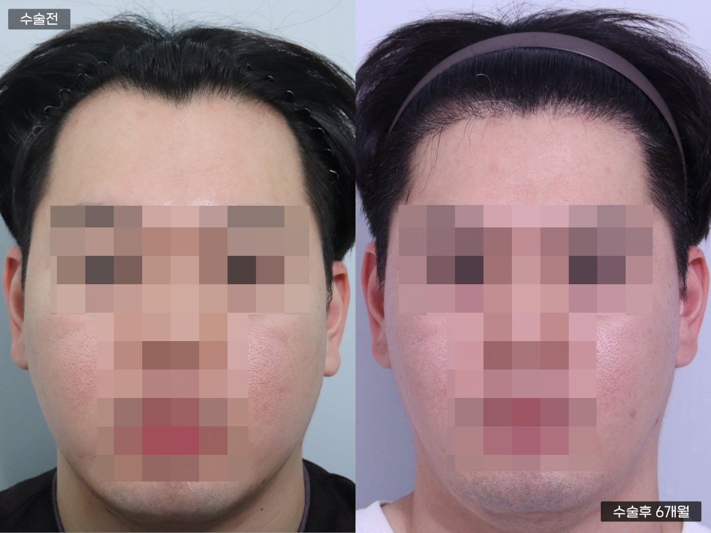 모발이식 [절개 모발이식(3500모)]