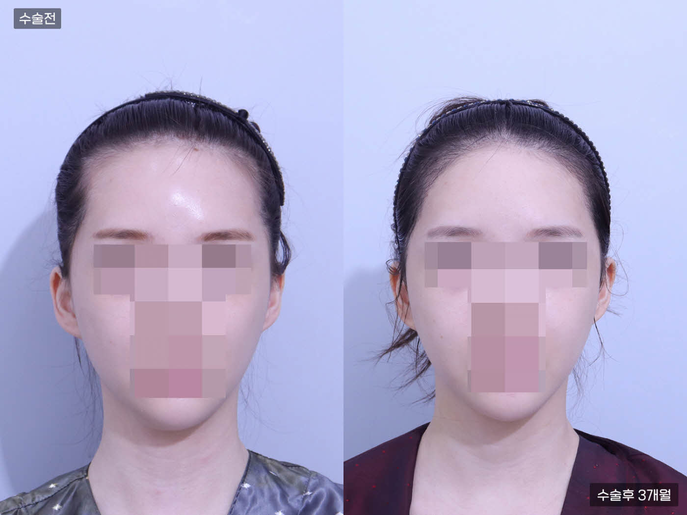 모발이식[비절개 모발이식(4000모)]