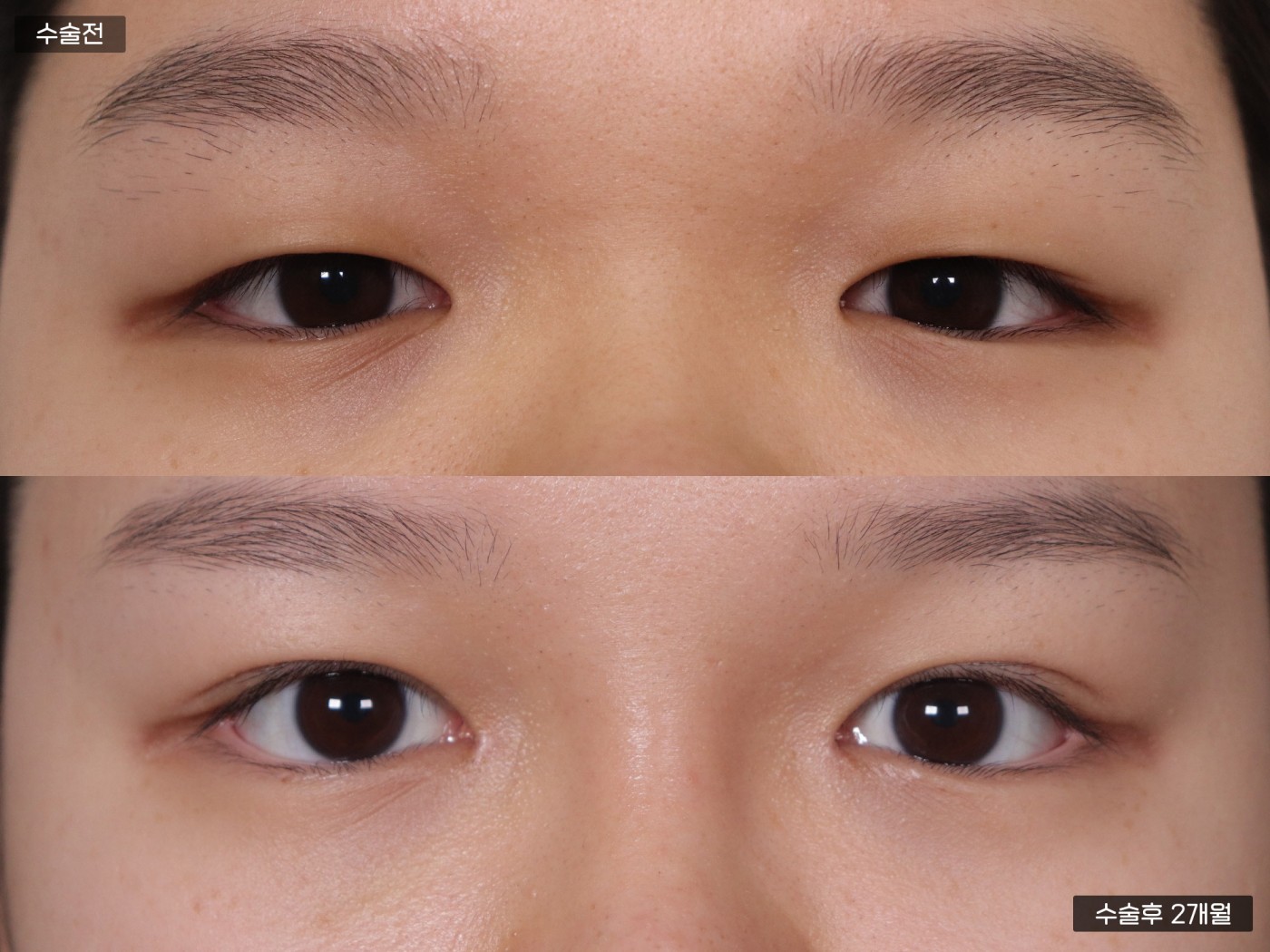 눈성형 [절개 쌍꺼풀 + 앞트임]