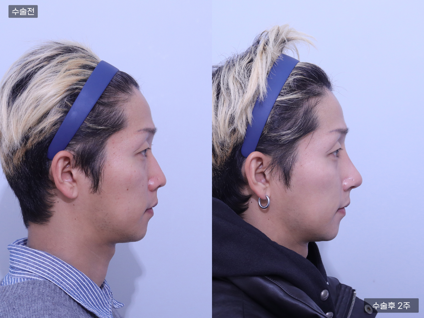 코끝 + 복코 + 매부리코