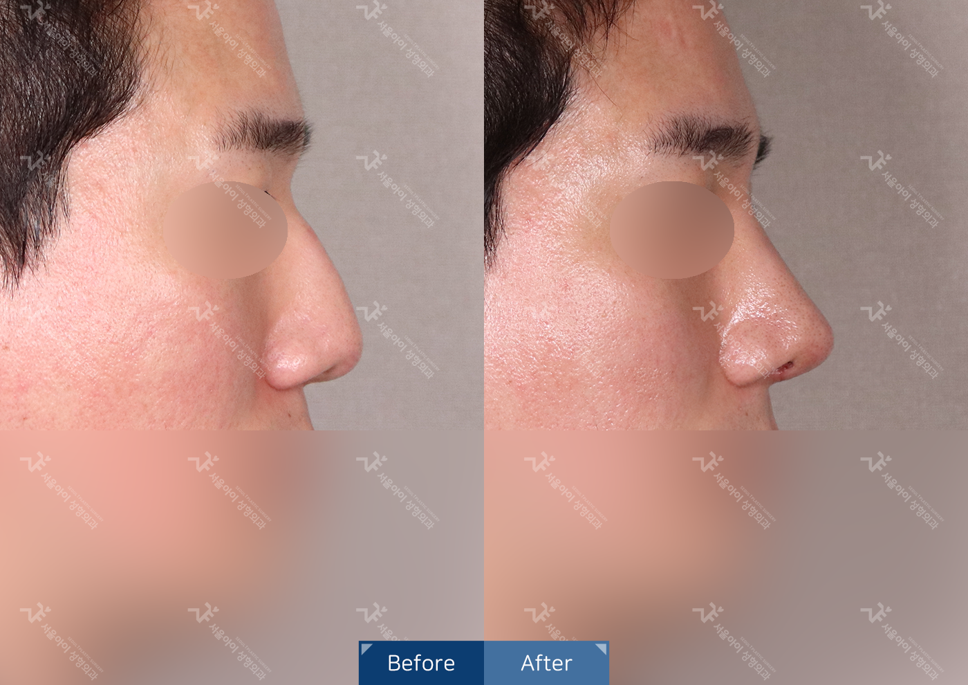 코성형 [기능코 3종]