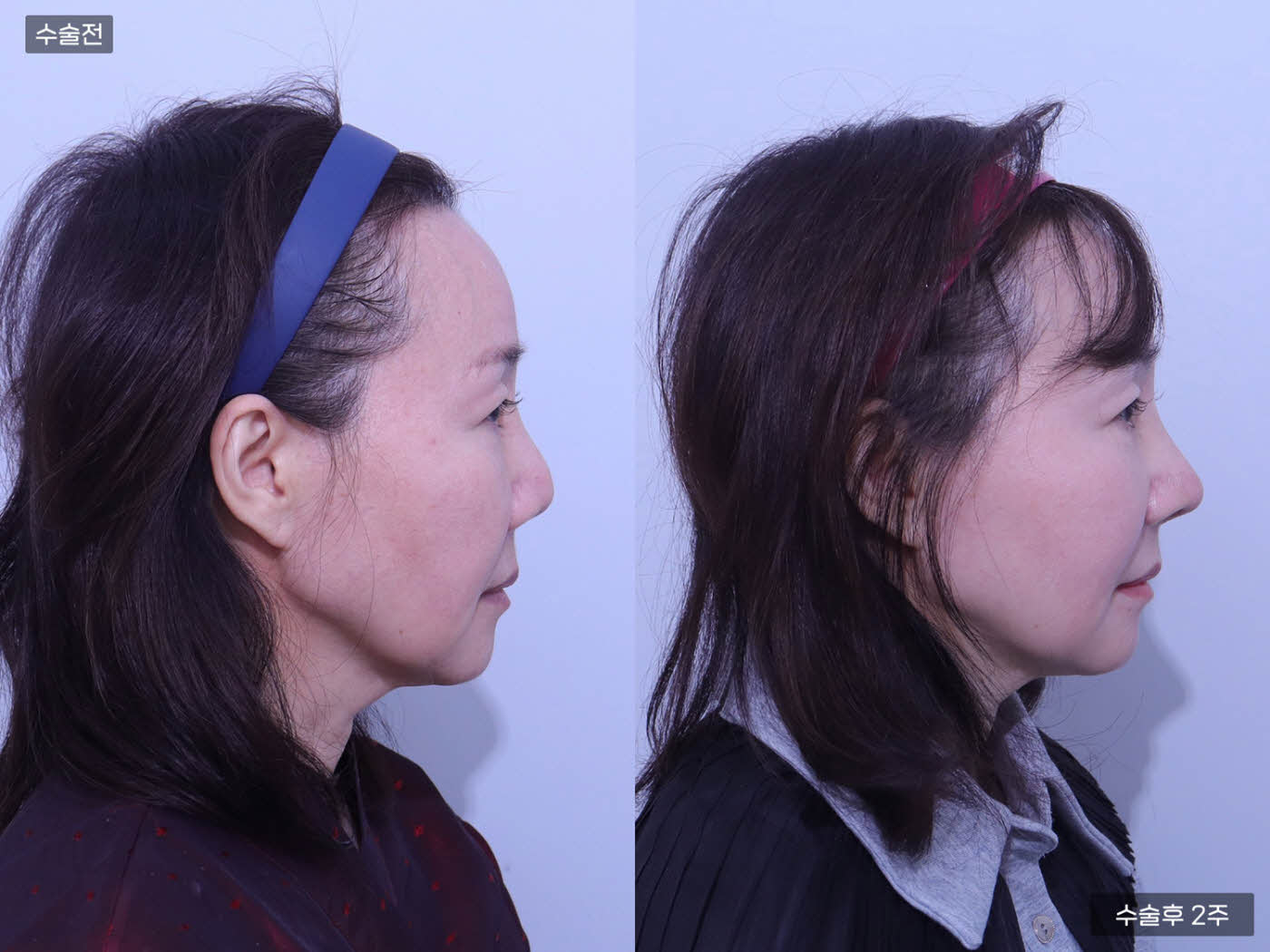 코끝(재수술) + 짧은코 + 매부리코