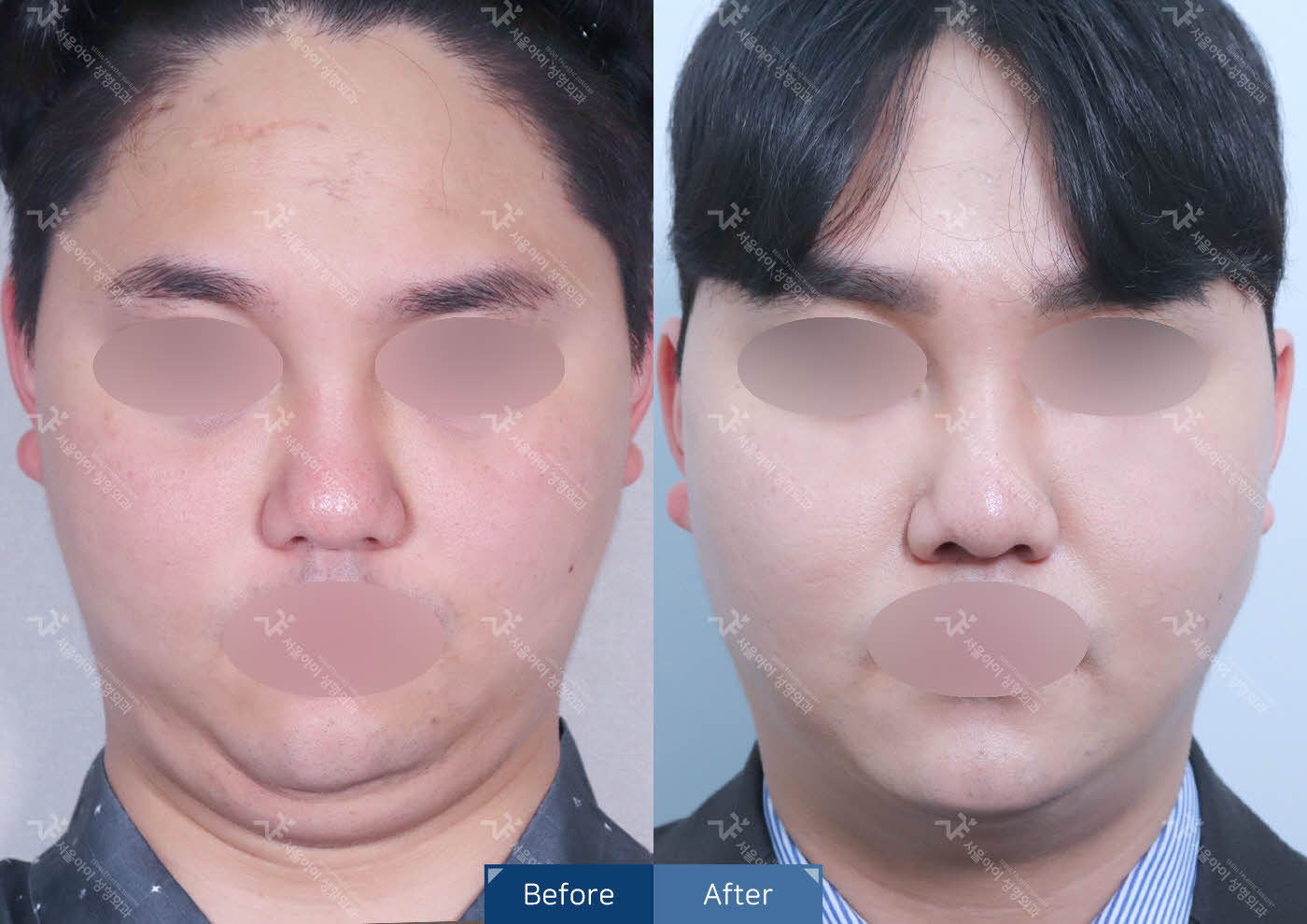 광대, 턱라인, 이중턱 얼굴지방흡입