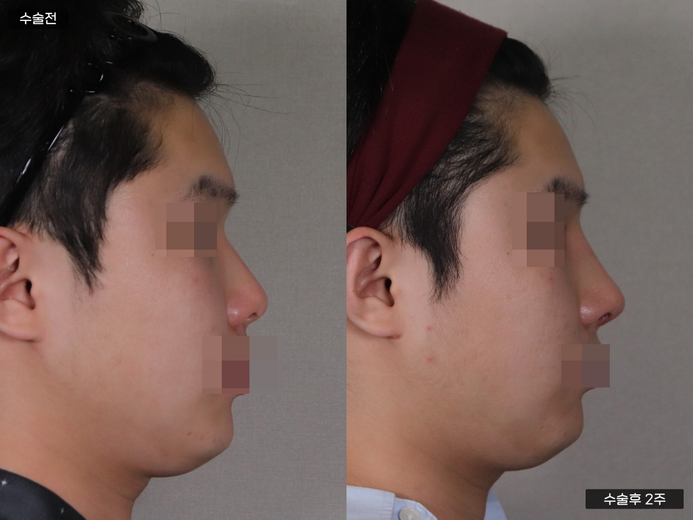 낮은코 + 복코 + 매부리코