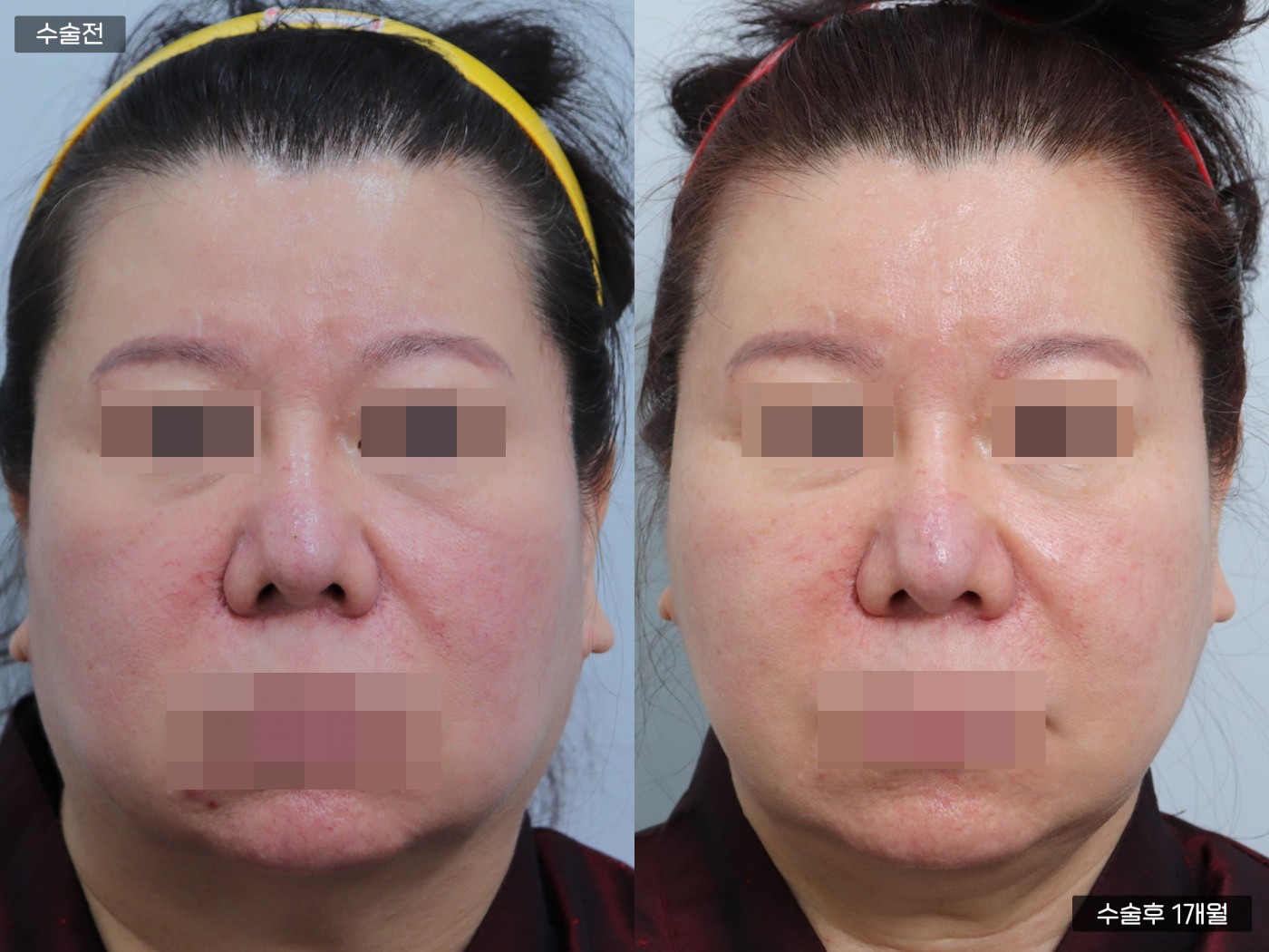 리프팅 [관자거상 + 실리프팅]