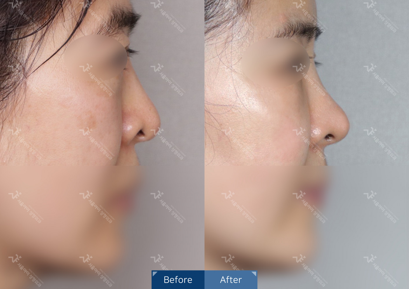 코성형 [코끝조각술+비중격+복코교정술]