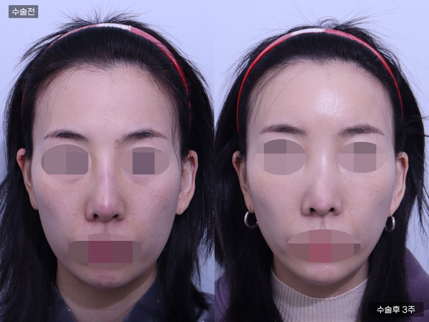 지방이식 [풀페이스]